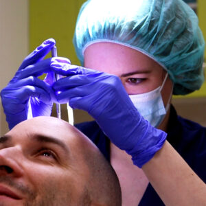 Norbert Kiss Transplantácia Vlasov Pred Po – PHAEYDE Clinic Bratislava